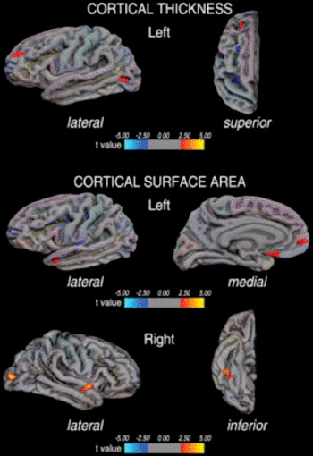 Image: Vertex-by-vertex analysis shows regional differences in cortical thickness and cortical surface area in patients with migraine compared with healthy control subjects (p < 0.01) represented on an averaged brain map. Regions of increased cortical thickness or surface area are shown in red (color coded according to t value), and regions of decreased cortical thickness or surface area are shown in blue (color-coded according to t value). Only the most representative views are shown. (Photo courtesy of Radiological Society of North America). Image: Vertex-by-vertex analysis shows regional differences in cortical thickness and cortical surface area in patients with migraine compared with healthy control subjects (p < 0.01) represented on an averaged brain map. Regions of increased cortical thickness or surface area are shown in red (color coded according to t value), and regions of decreased cortical thickness or surface area are shown in blue (color-coded according to t value). Only the most representative views are shown. (Photo courtesy of Radiological Society of North America).